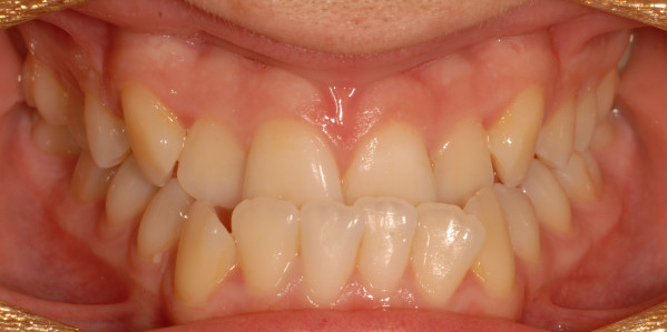 Alix before Orthodontic Treatment