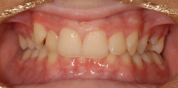 Angus Before Orthodontic Treatment