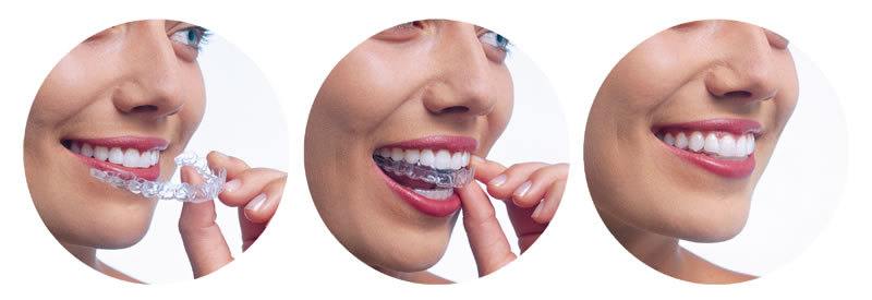 invisalign