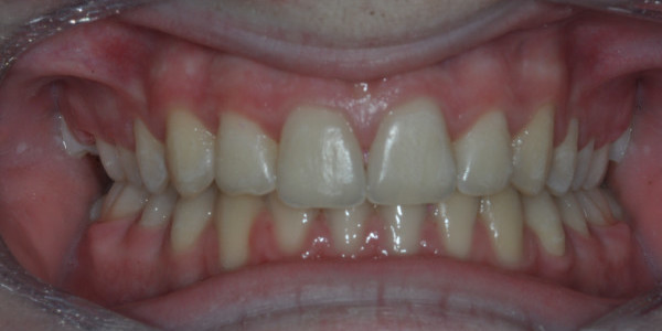 Angus after Orthodontic Treatment