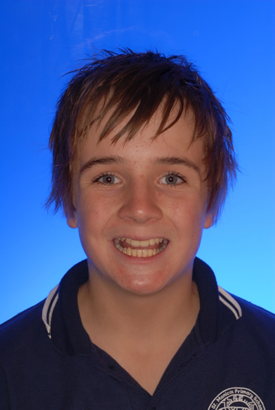 Angus Before Orthodontic Treatment