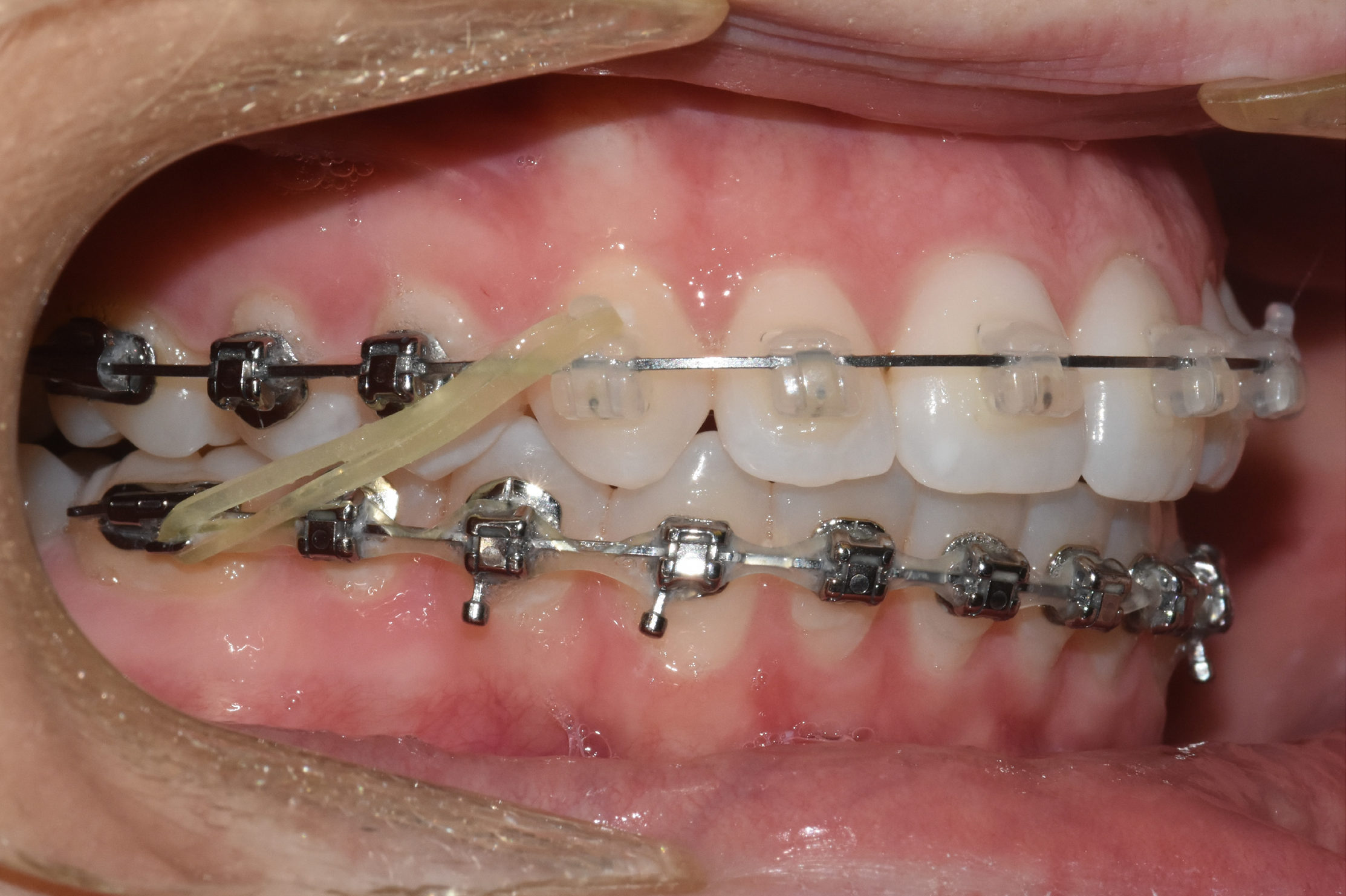 The effects of wearing Elastics (Rubber Bands) during braces..